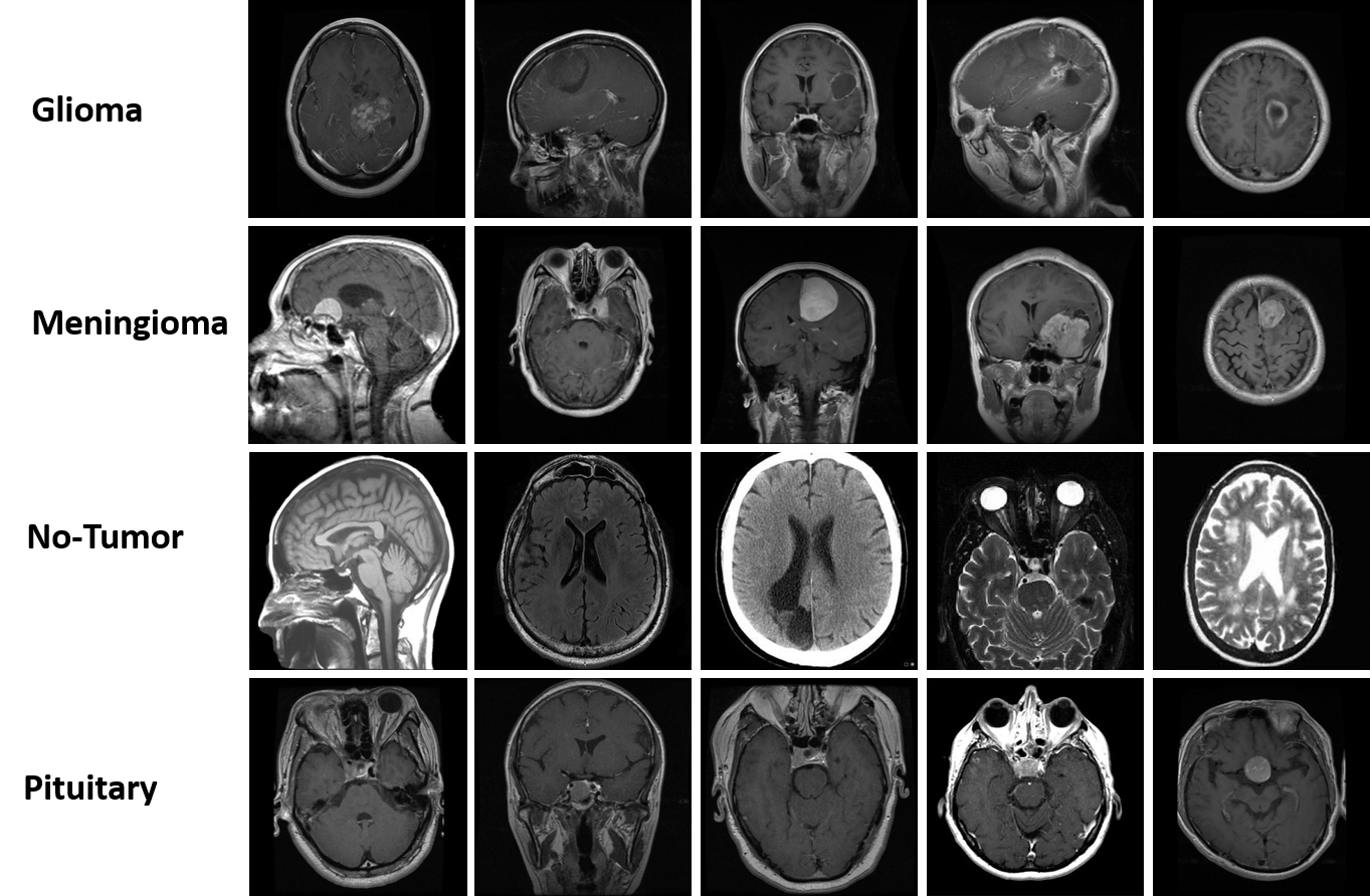 Brain Tumor Classification